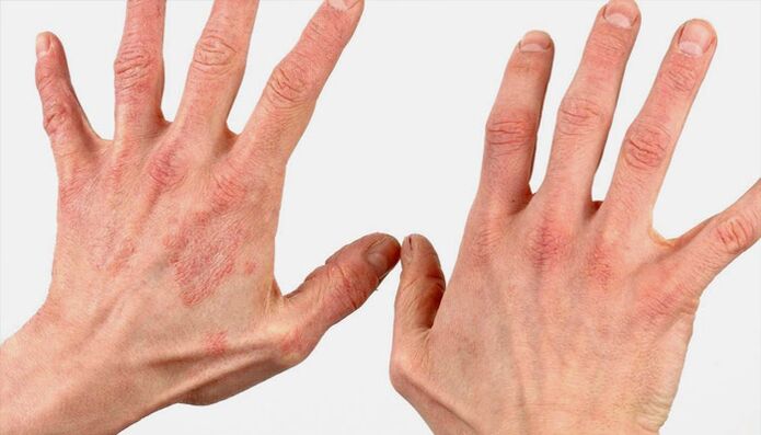 metode de tratare a psoriazisului cu remedii populare