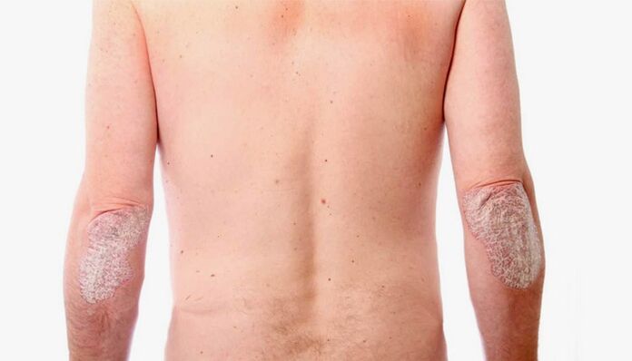 remedii populare pentru tratamentul psoriazisului
