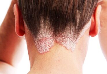 Psoriazis pe cap