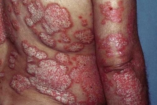 Psoriazis