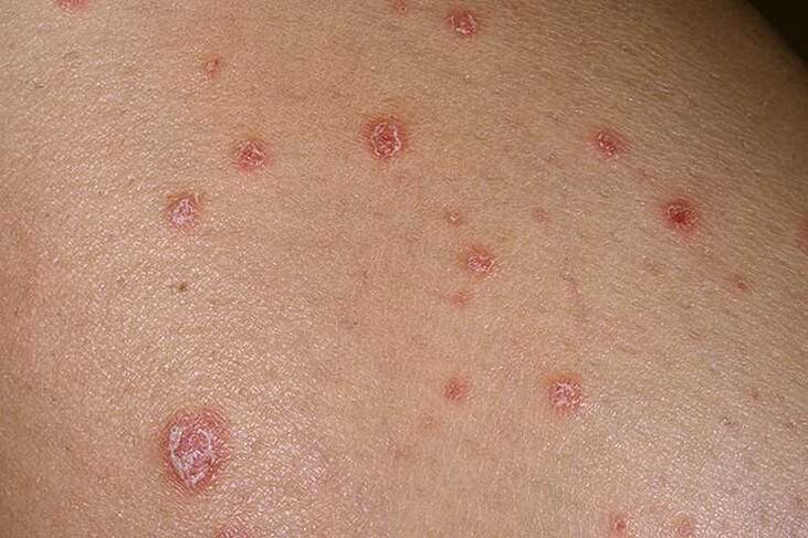 Cauzele psoriazisului
