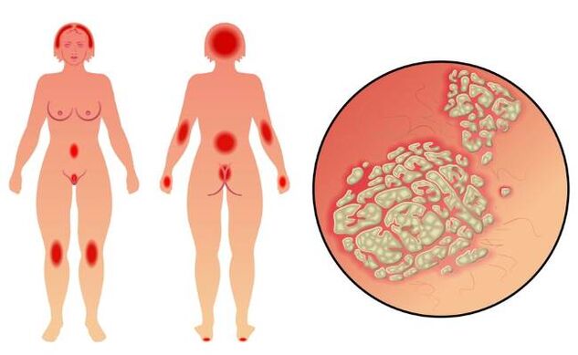 Simptomele psoriazisului