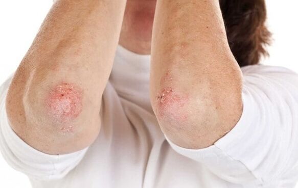 psoriazis