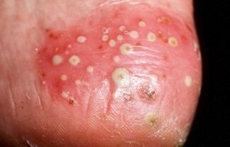 Psoriazisul este pusular