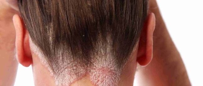 Psoriazis al capului