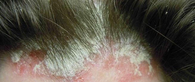 Psoriazis pe cap