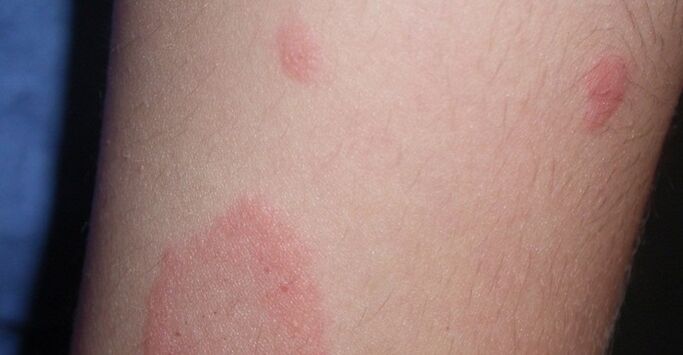 psoriazis