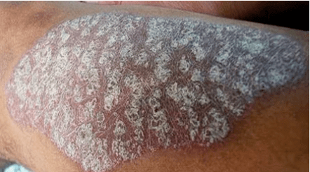 Patogeneza psoriazisului