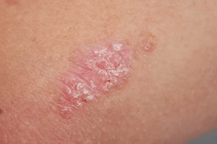Psoriazis - stadiul inițial