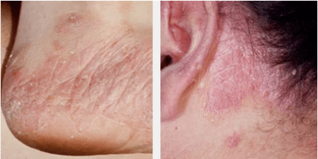 Tipuri de psoriazis