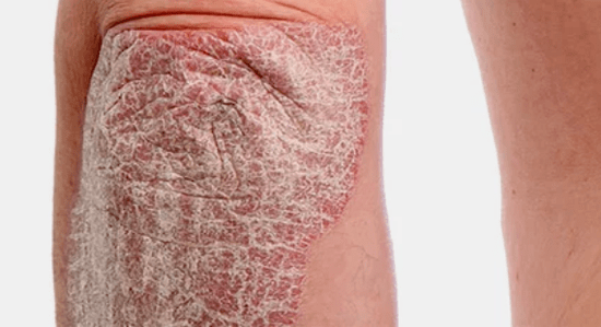 psoriazis