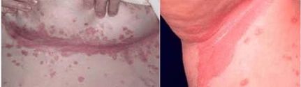 Formă atipică de psoriazis