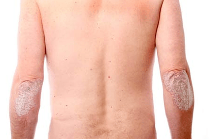 Simptome generale ale psoriazisului