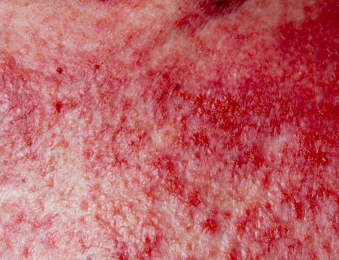 Forma avansată de psoriazis