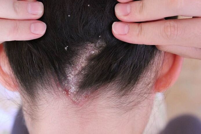 Psoriazisul pe cap