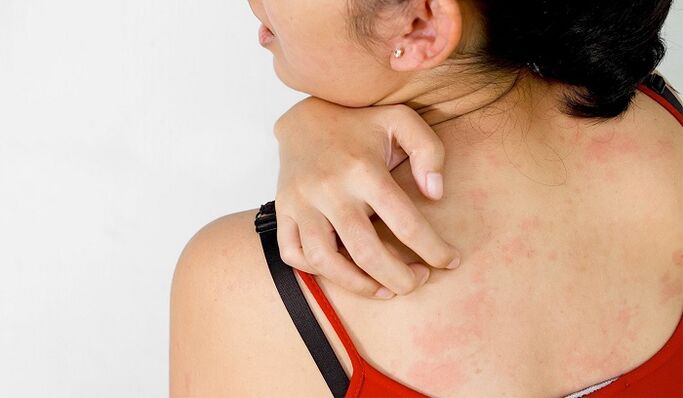 Psoriazisul pe spate