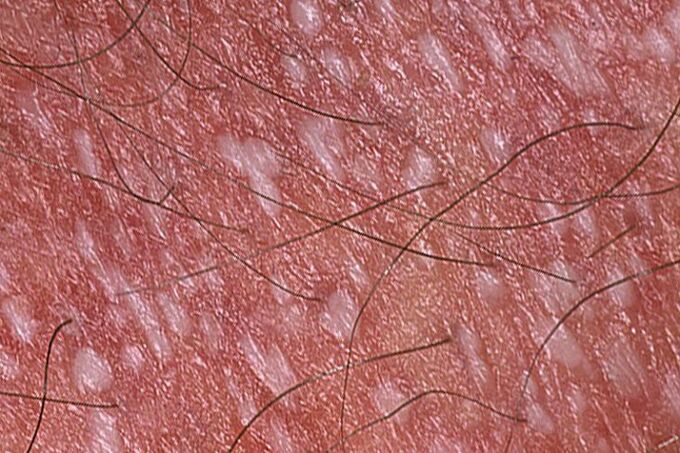 Psoriazisul pustular