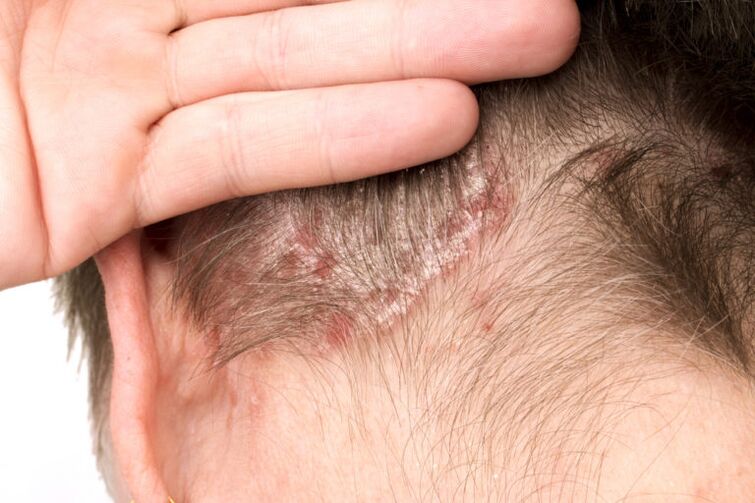 Exacerbarea psoriazisului pe cap