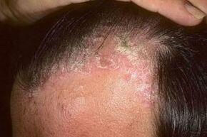 Posriazis pe scalp