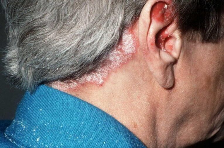 Psoriazisul pe cap