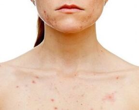 Pe ce părți ale corpului apare psoriazisul