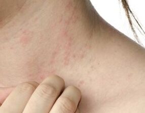principalele simptome ale psoriazisului