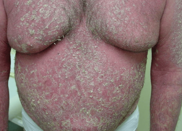 Eritrodermia psoriazica pe corp
