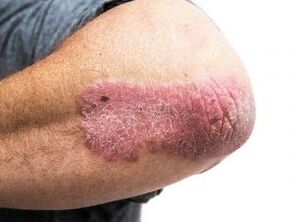 Psoriazis în plăci pe cot