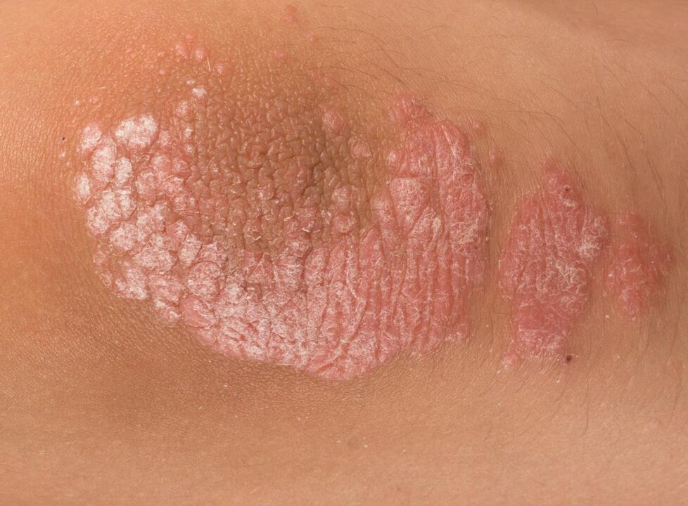 Psoriazis