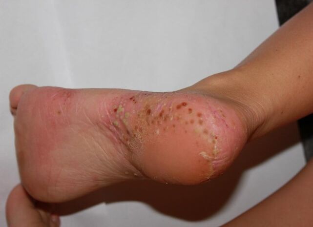 Psoriazisul palmoplantar