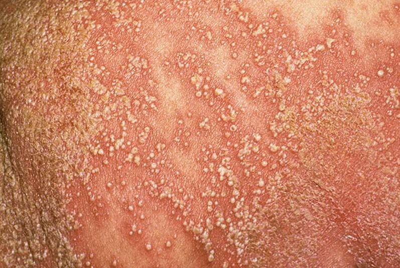 Psoriazisul pustular