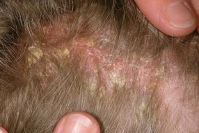 Psoriazis pe cap