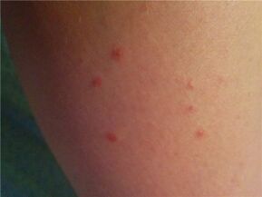 Psoriazis pe piele